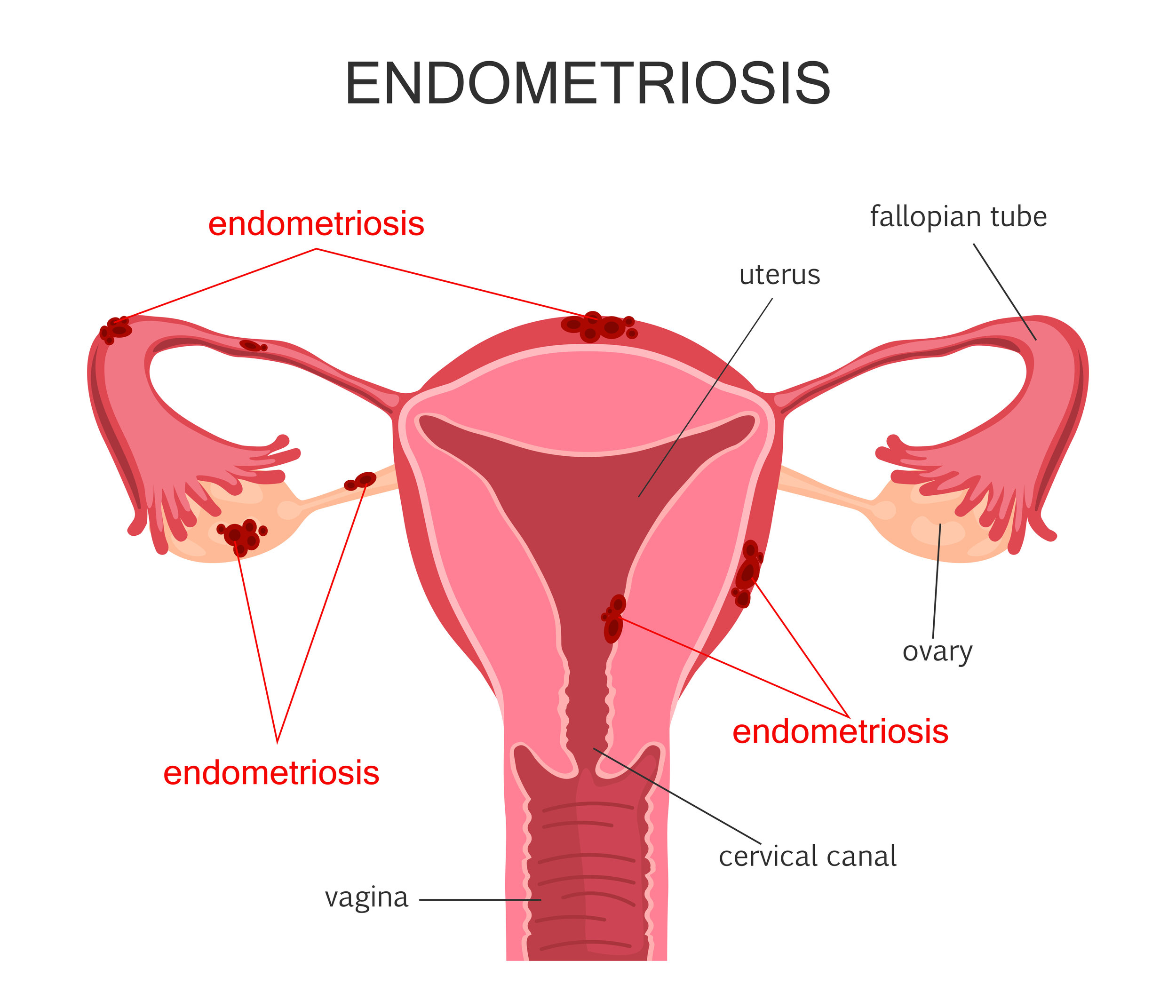 Endometriosis Diagnosis and Treatment by Dr. Shilpa Dhameja, Gynecologist Vasant Kunj